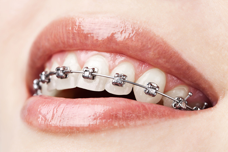 用钢丝和钢制托槽制成,是现在运用最广的牙套. 2,自锁牙套.