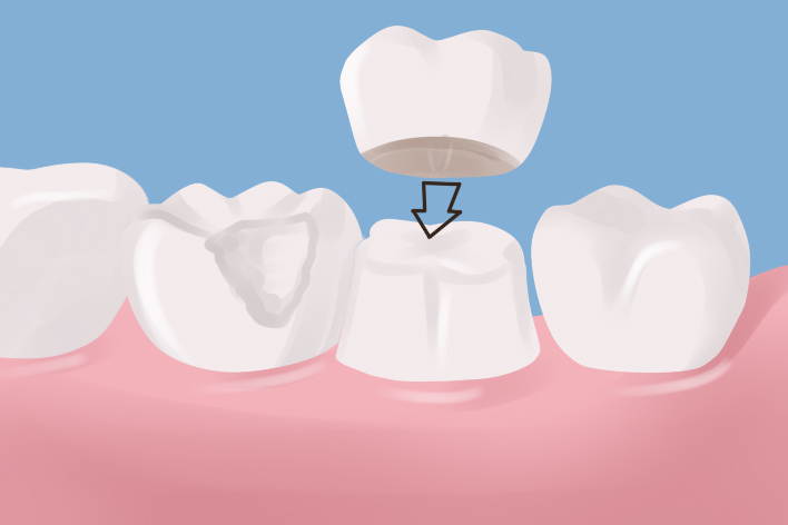 什么情况下需要进行牙冠修复?