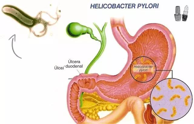 helicobacter pylori darm beschwerden
