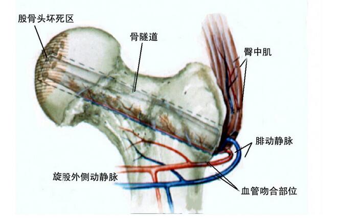 股骨头坏死